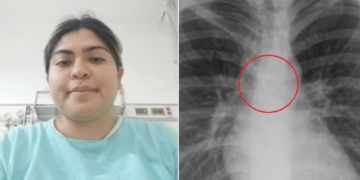 Mulher descobre que piercing no nariz que havia sumido estava alojado nos pulmões