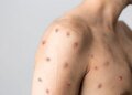 Rio de Janeiro registra 74 casos de Mpox em dois meses